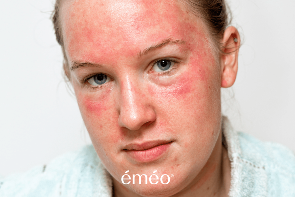 Allergies et réactions aux cosmétiques – Emeo Swiss