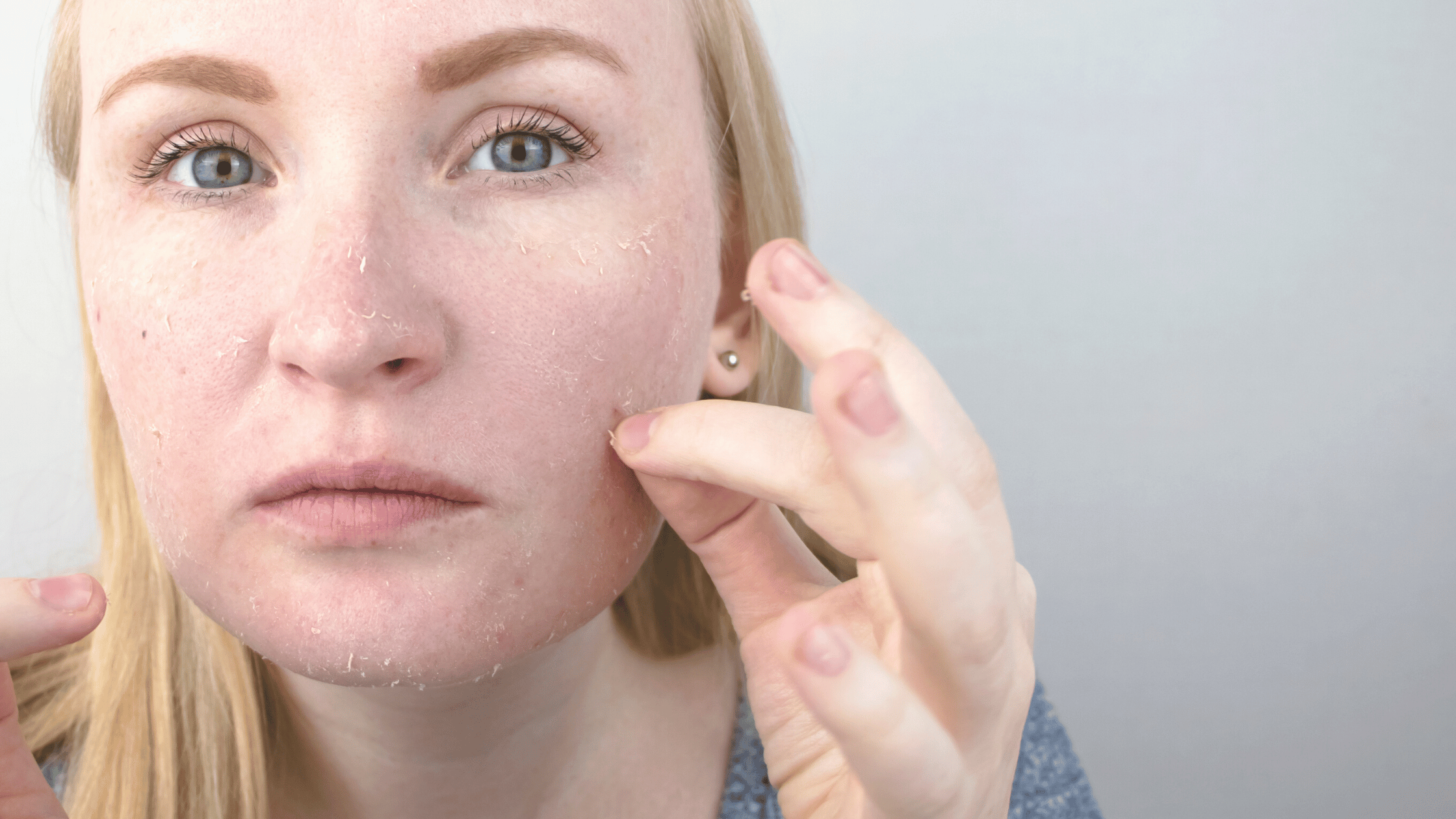 Why is my skin peeling? Causes and solutions Emeo Swiss