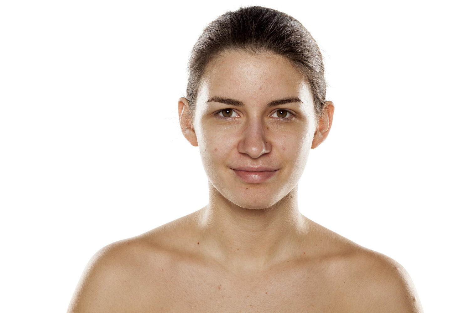 Soigner l’acné naturellement durant la grossesse