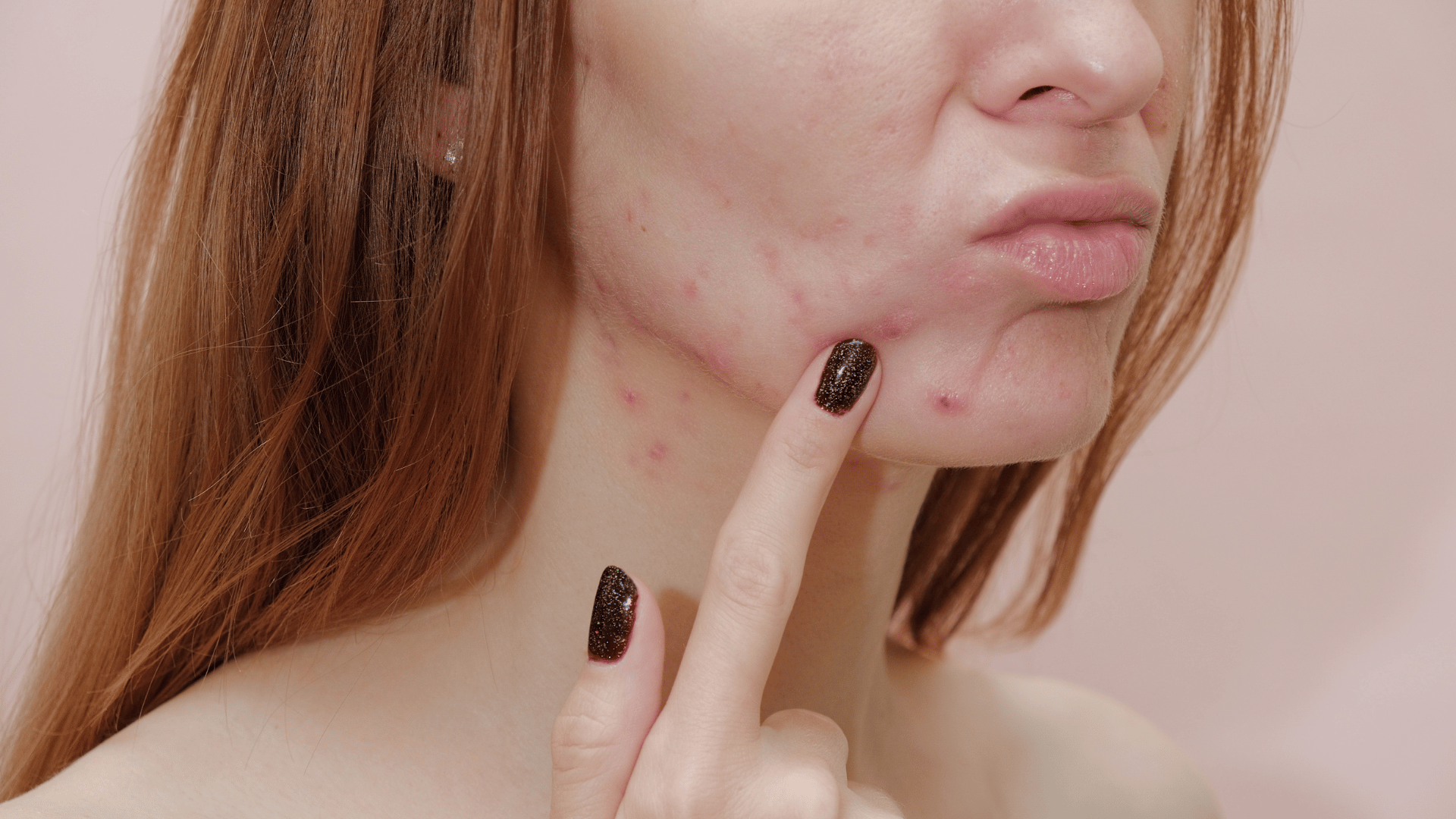Les causes et les solutions contre l’acné