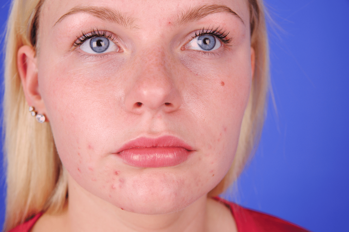 Comment soigner l’acné chez l’adulte?