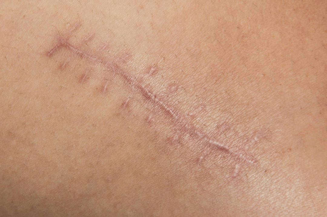 3 étapes pour soigner vos cicatrices