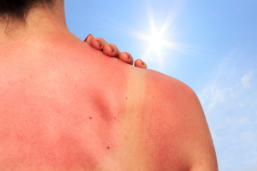 Comment soulager les coups de soleil naturellement