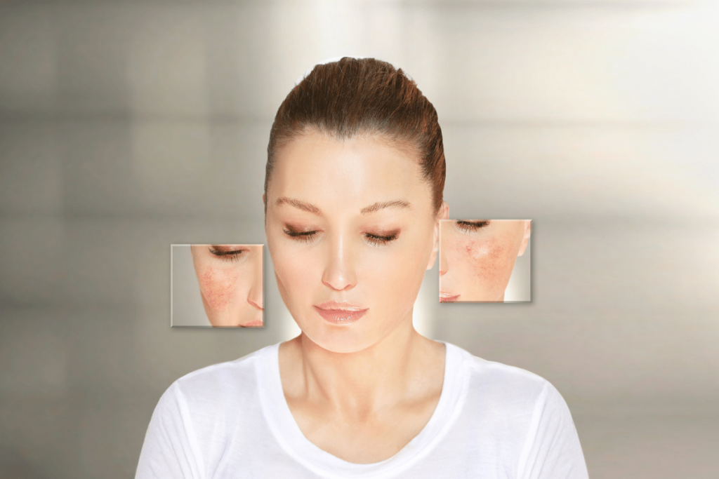 Couperose et Peaux à Rougeurs : Soins Naturels et Routine Apaisante