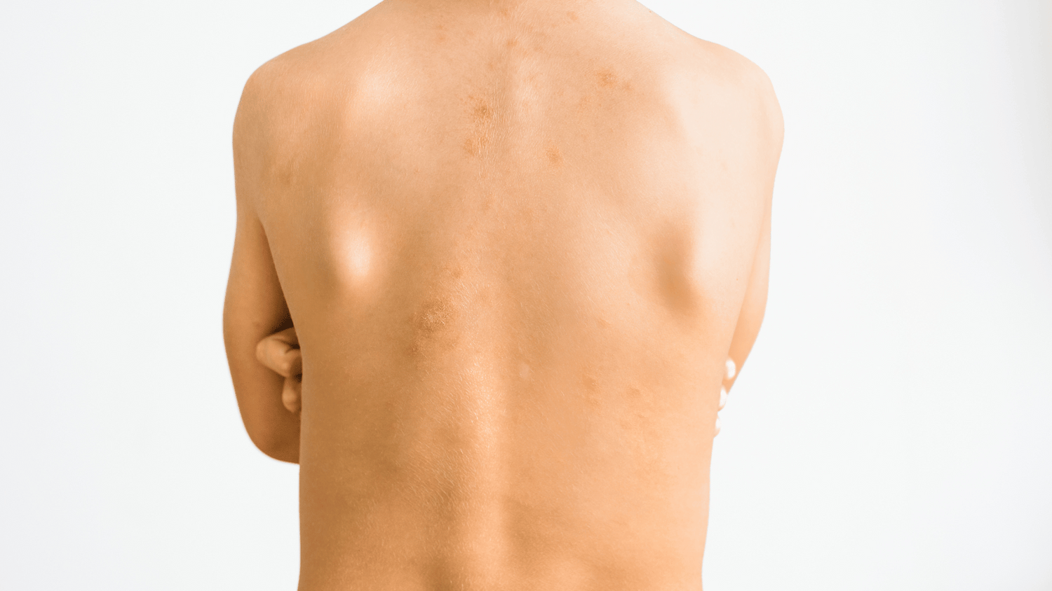 Comment soigner le Pityriasis Rosé de Gibert