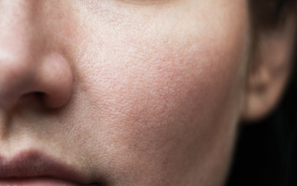 Comment resserrer les pores dilatés naturellement?