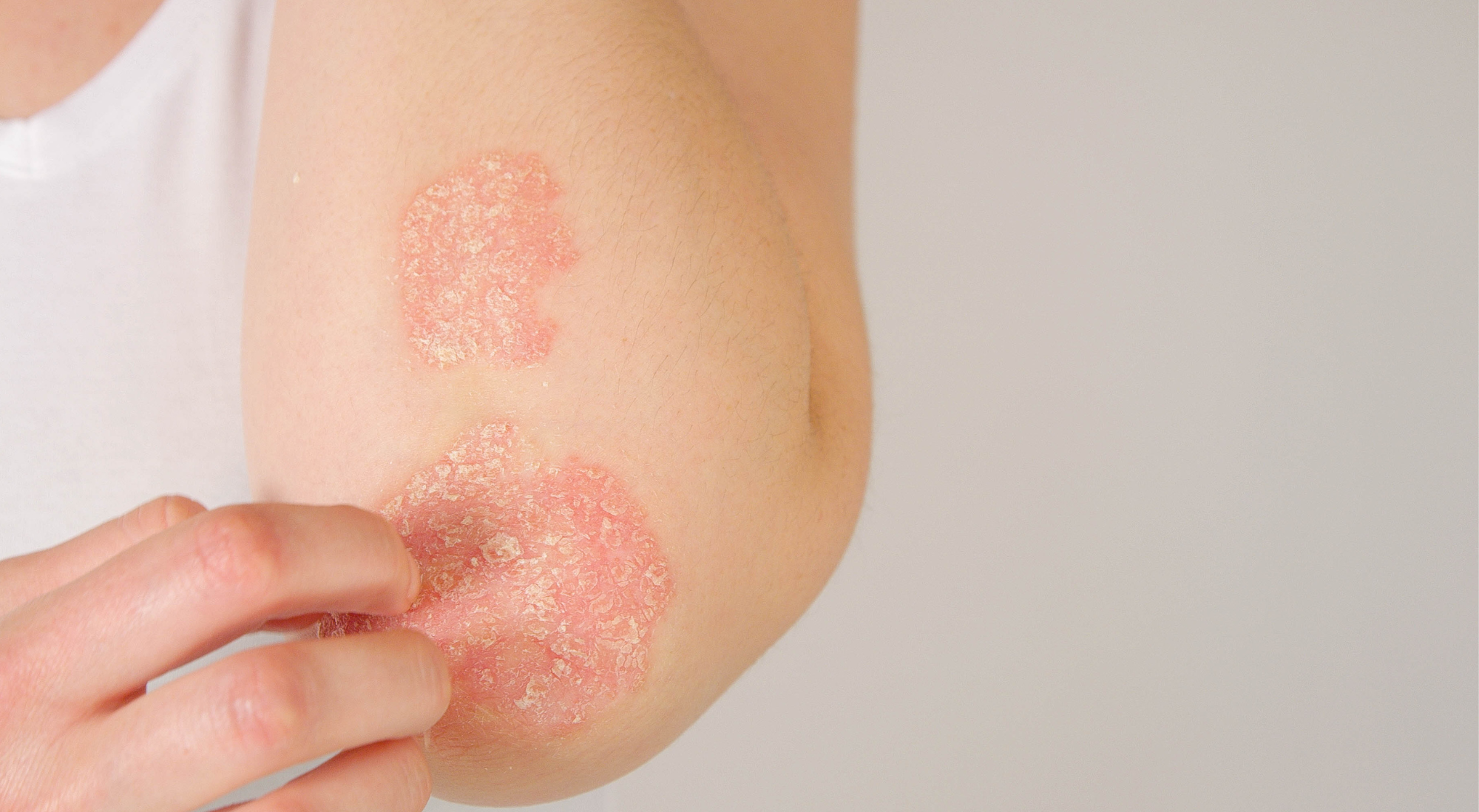 soignez votre psoriasis naturellement